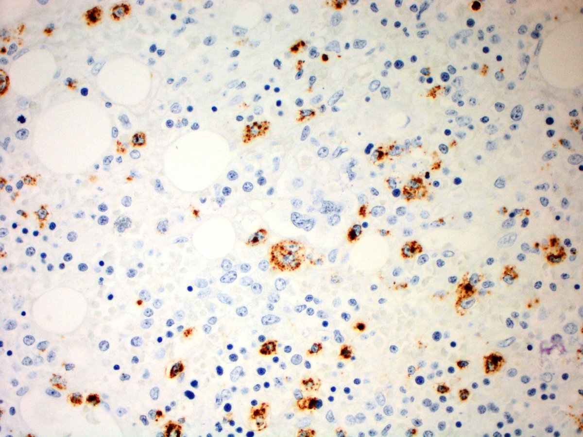 Atypical lymphoid cells staining for Granzyme B (Immunoperoxidase, 400x)